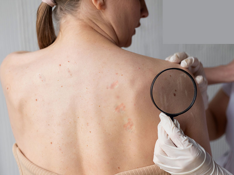 Dermatologist checkin a patient's moles