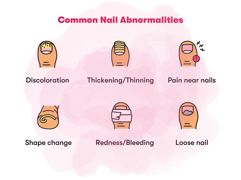 common nail abnormalities