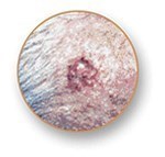 Basal Cell Carcinoma (BCC) image