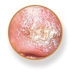 Melanoma image