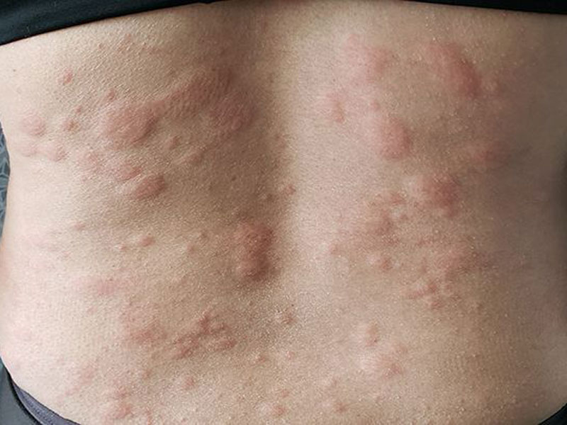 Hives (Urticaria) image