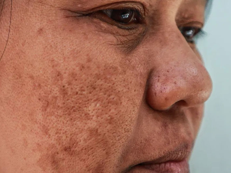 Melasma image