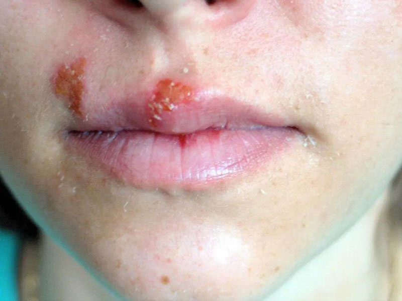 Common Types of Skin conditions : Herpes