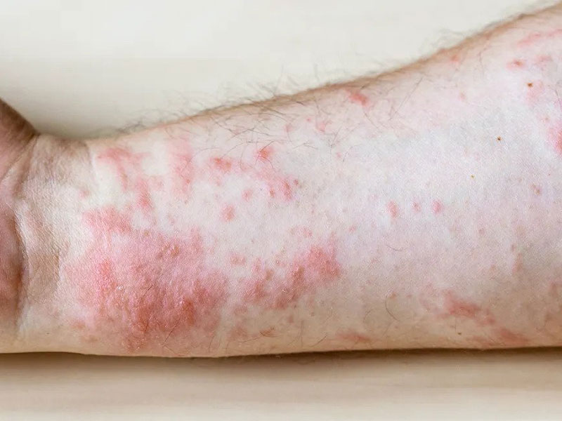 Types of Skin conditions :Hives
