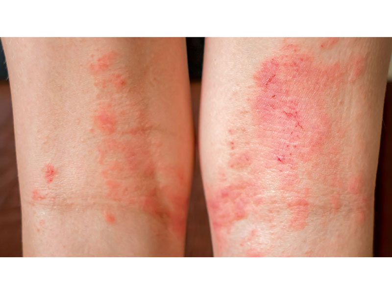 Dermatitis image