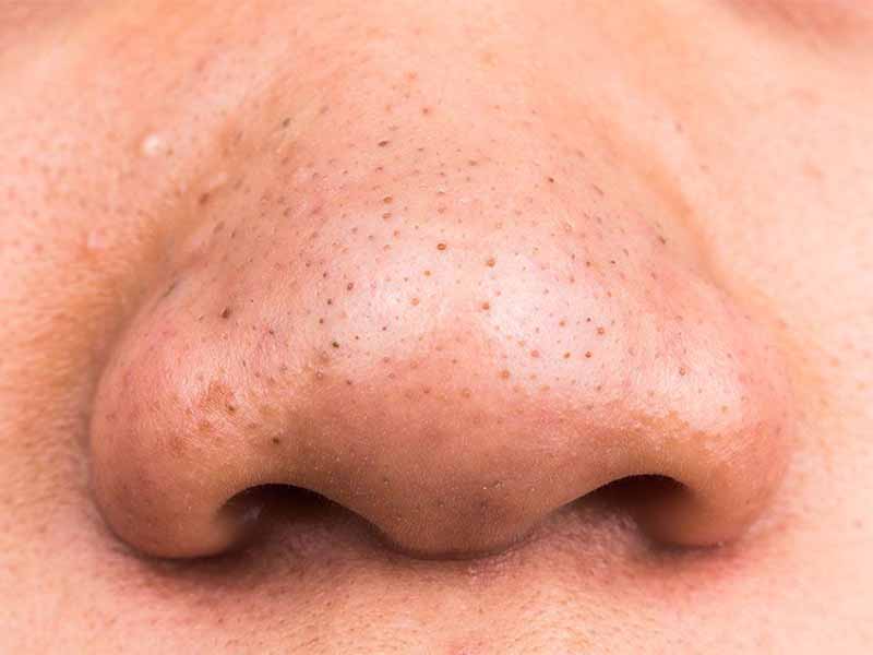 Blackheads on the nose