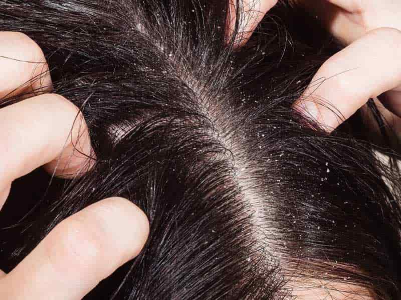 Dandruff