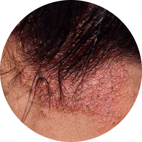Allergic contact dermatitis 