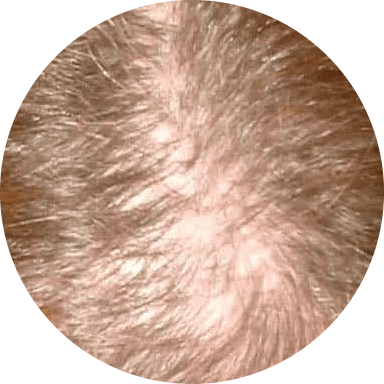 Androgenetic Alopecia