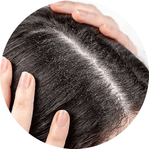 Dandruff caused by dry skin