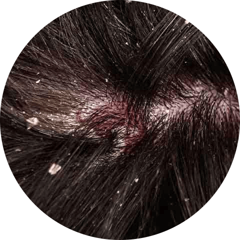 Dandruff caused by fungi