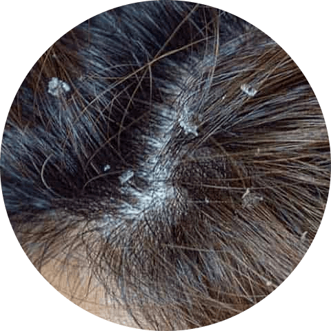 Dandruff on dry skin