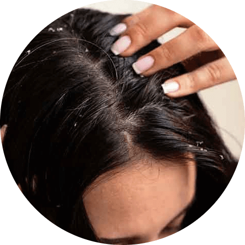 Dandruff on greasy skin