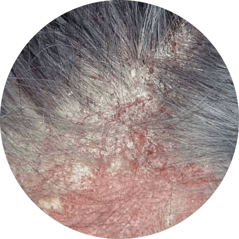 Dandruff and Eczema