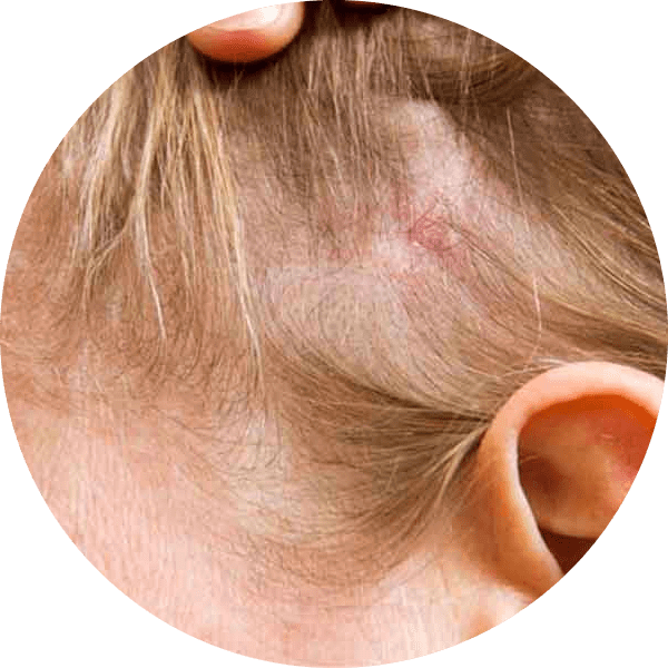 Ringworm on the scalp