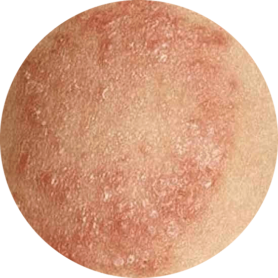 Ringworm vs. Eczema