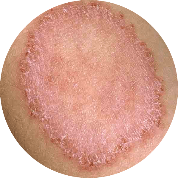 Ringworm Rash on Skin