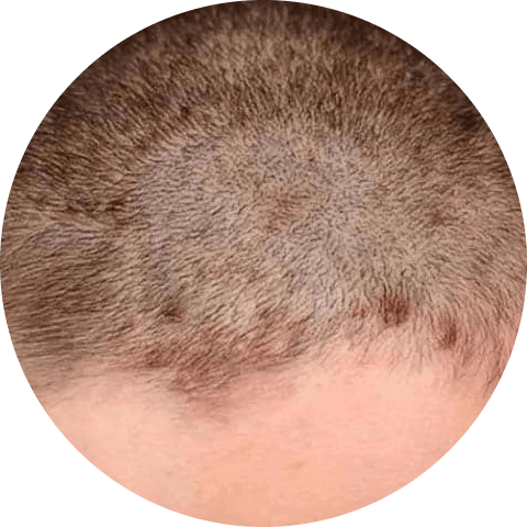 Scalp Eczema