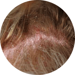 Seborrheic dermatitis