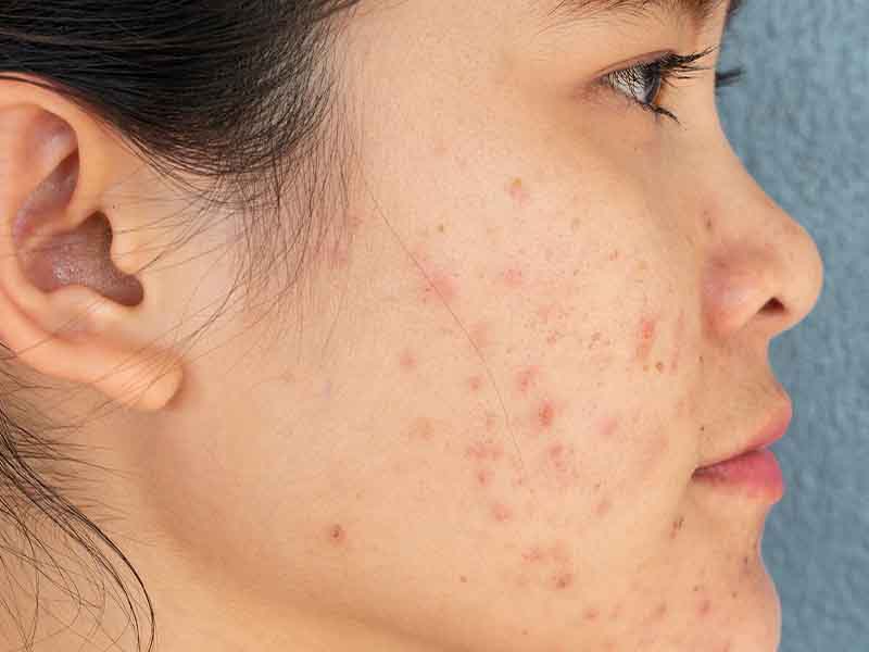 Pimples on a person's face