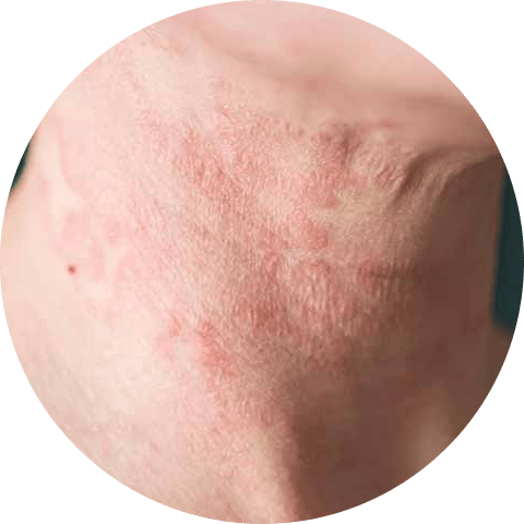 Eczema on the neck