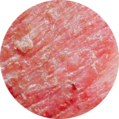 Signs of Eczema on the skin