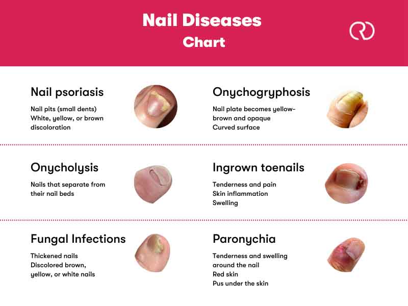 Nail diseases chart