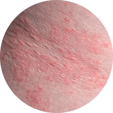 Ringworm vs. Psoriasis