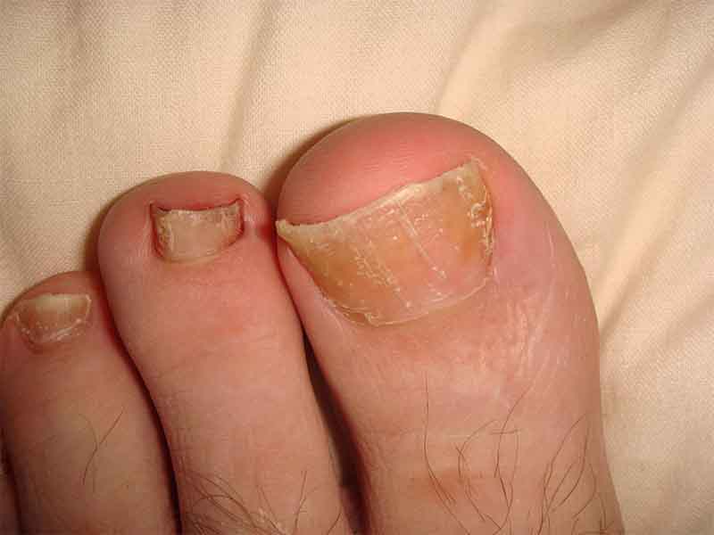 Psoriasis on toenails