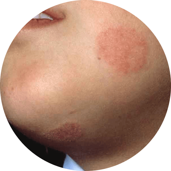 Ringworm on a Child's Chin