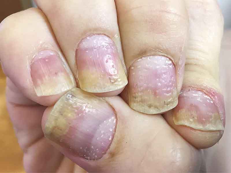 Psoriasis on fingernails