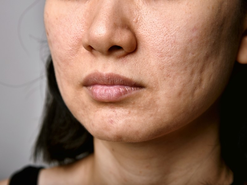 Woman with acne scars 