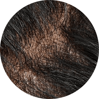 Signs of hair loss on the head