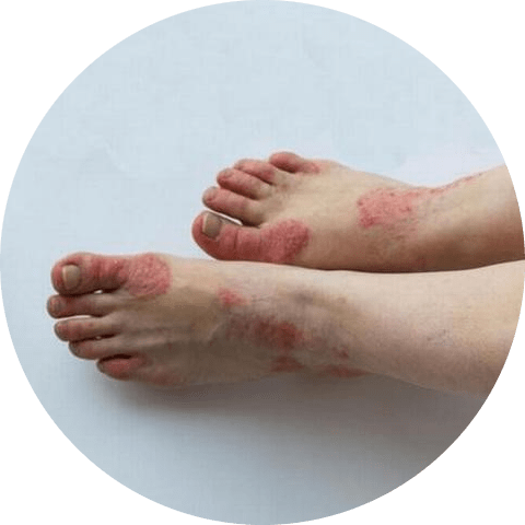 Psoriasis on the feet