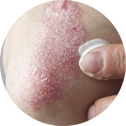 Treatment Options for Psoriasis