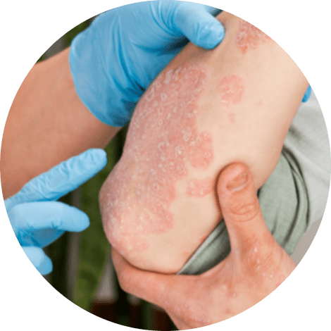 Psoriasis diagnosis
