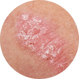 Symptoms of psoriasis on elbows