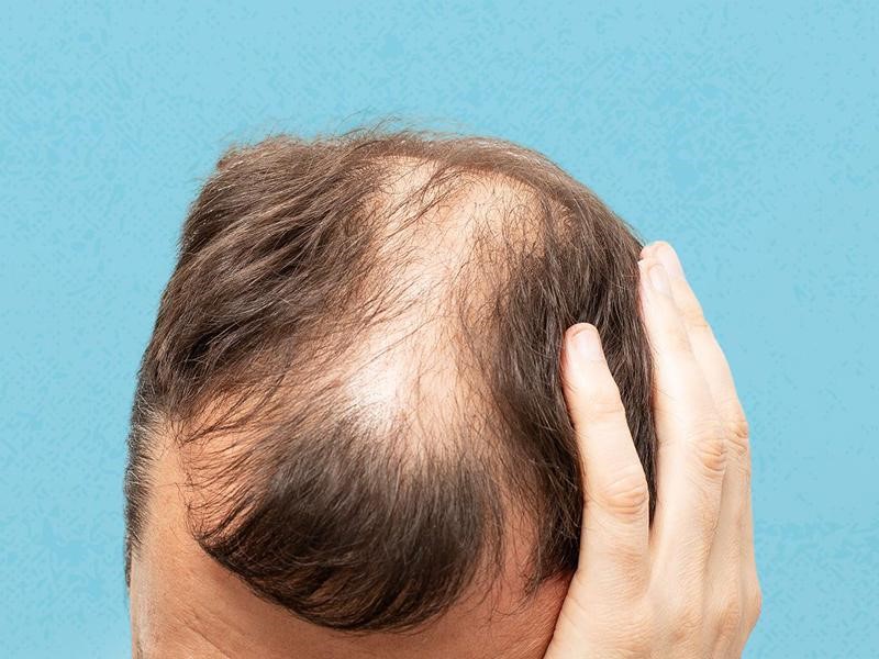 Signs of hair loss