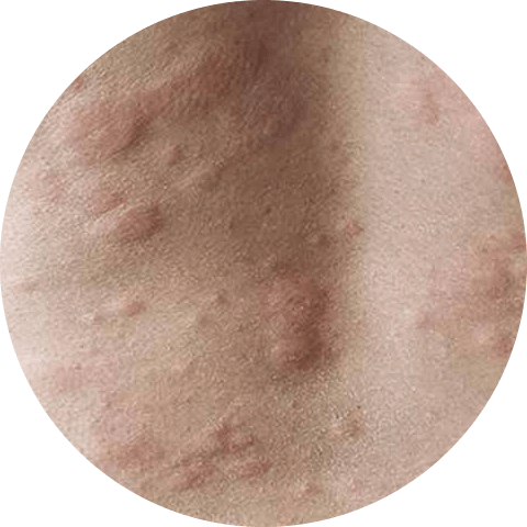 Signs of hives on the back
