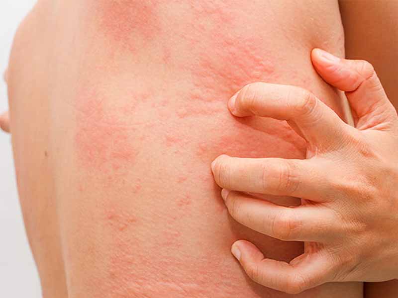 Symptoms of Hives on the skin