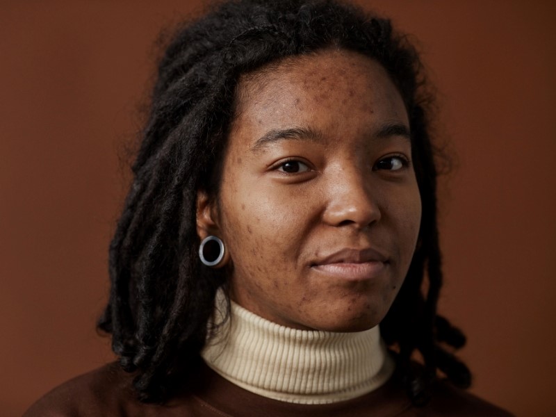 A dark-skined person with acne