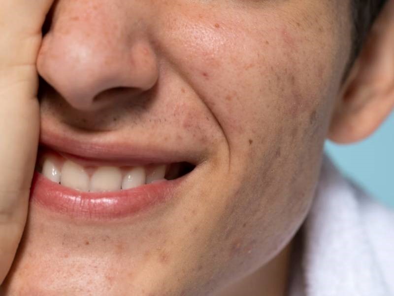 Definition of Acne Scars