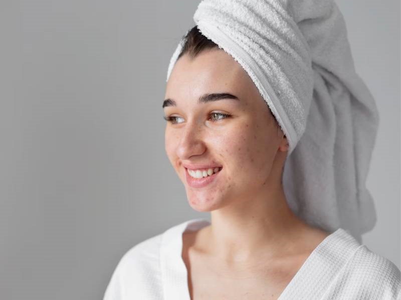 Causes of Acne Scars