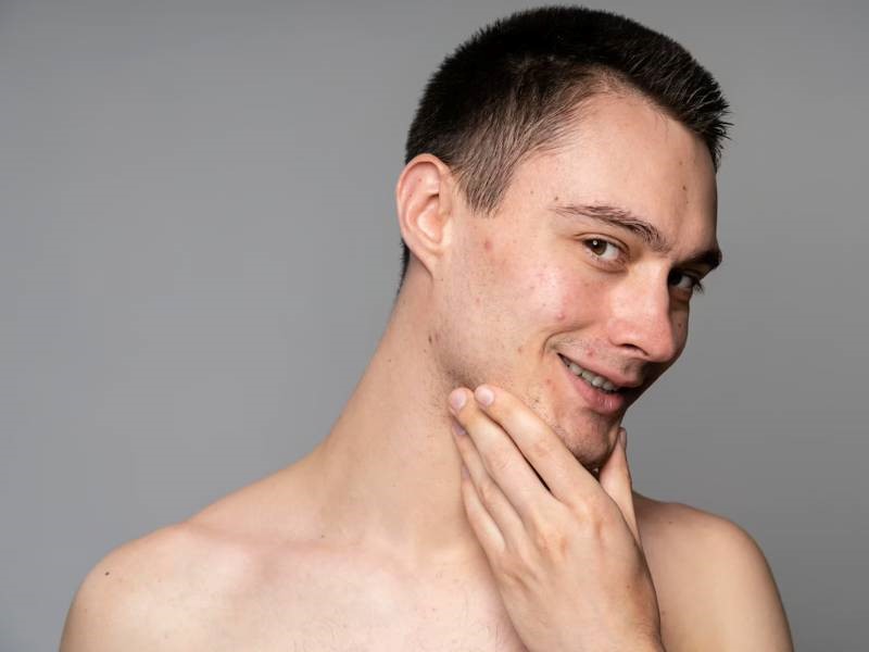 Acne scar on face treatment