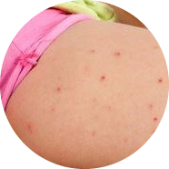 Folliculitis symptoms on the leg