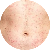Symptoms of Folliculitis on stomach