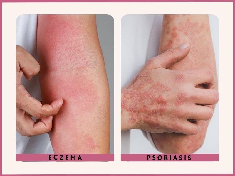 Psoriasis vs Eczema Photos