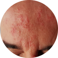 Red pimple-like on the forehead
