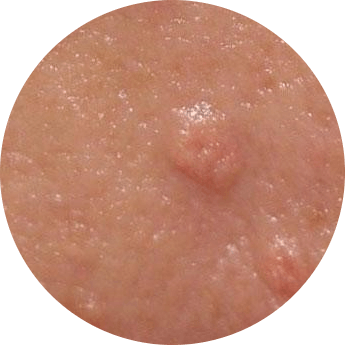 Bumps of sebaceous hyperplasia