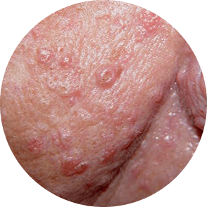 Sebaceous Hyperplasia On Face